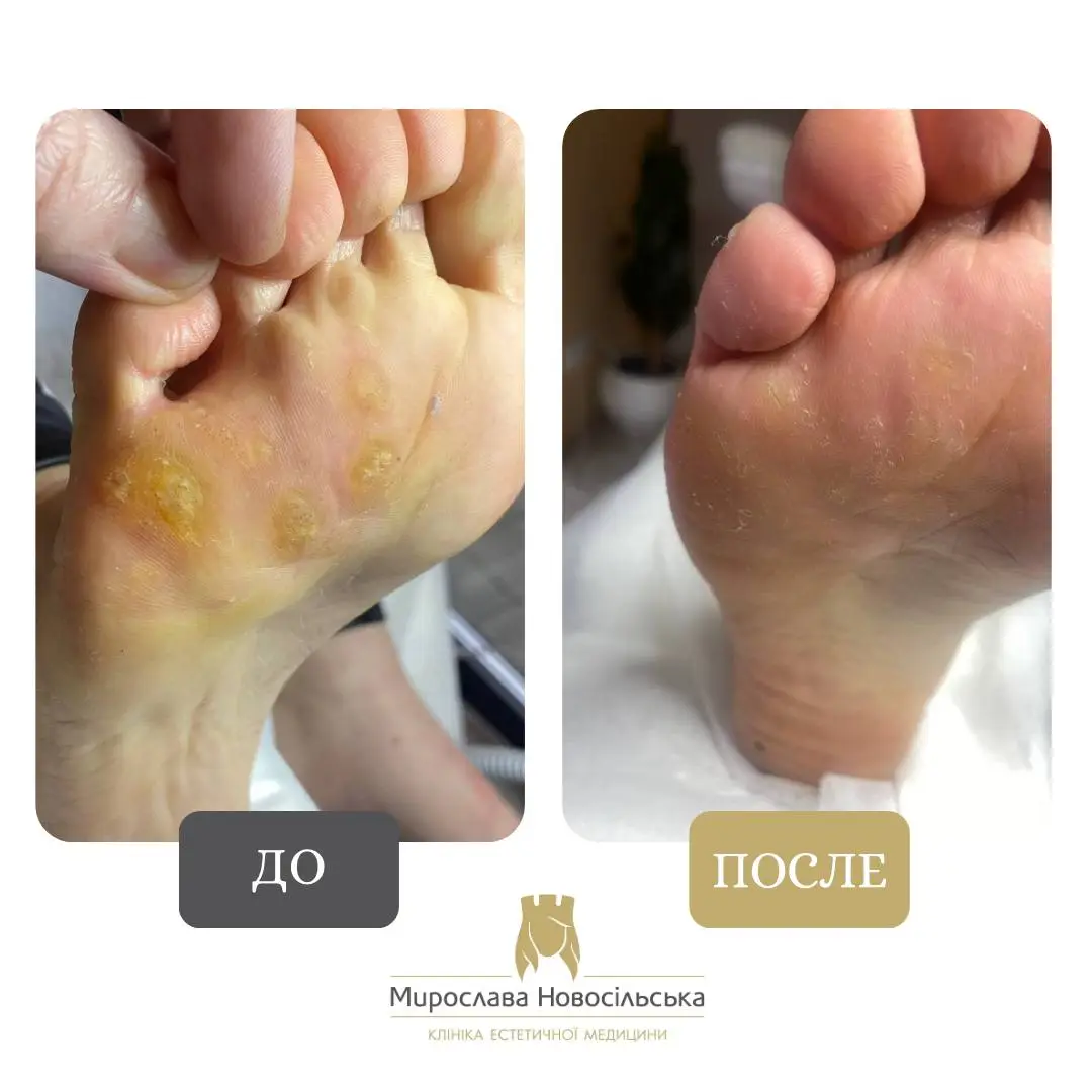 Замораживание бородавок, фото 2