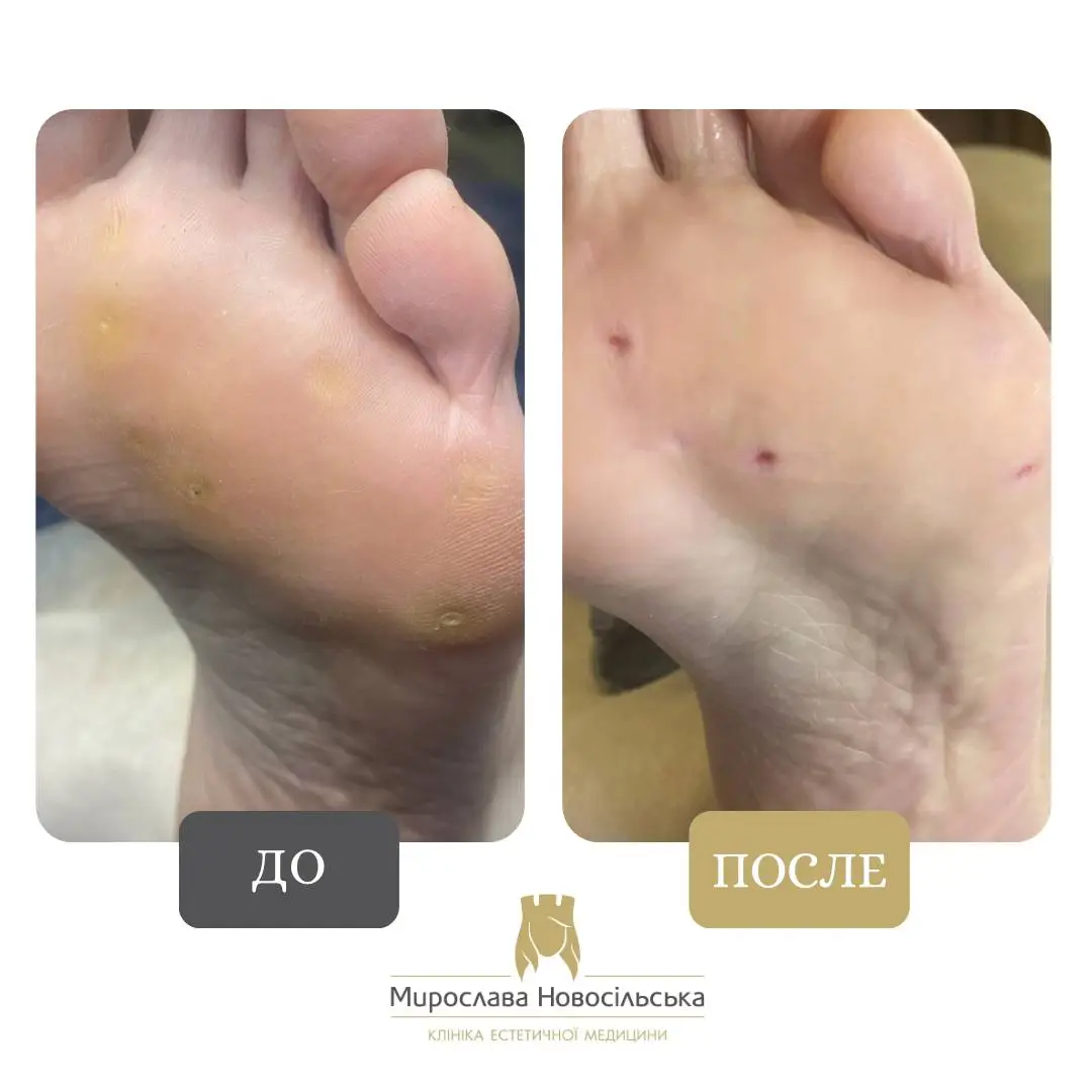 Замораживание бородавок, фото 8