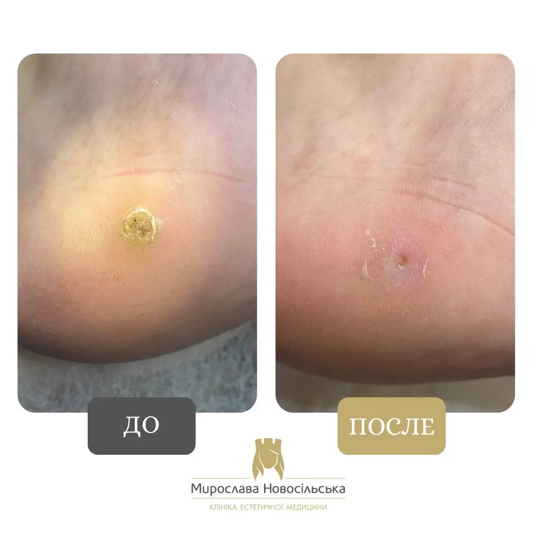 Замораживание бородавок, фото 9