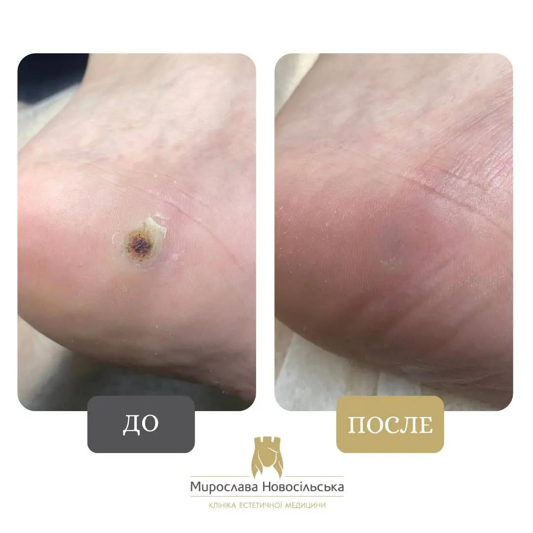 Замораживание бородавок, фото 13