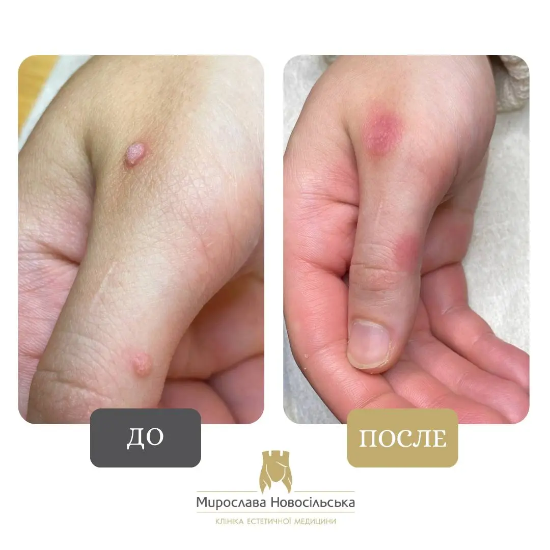 Замораживание бородавок, фото 10