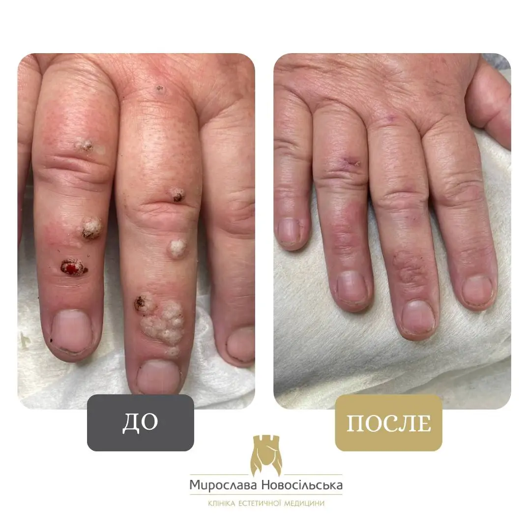 Замораживание бородавок, фото 14