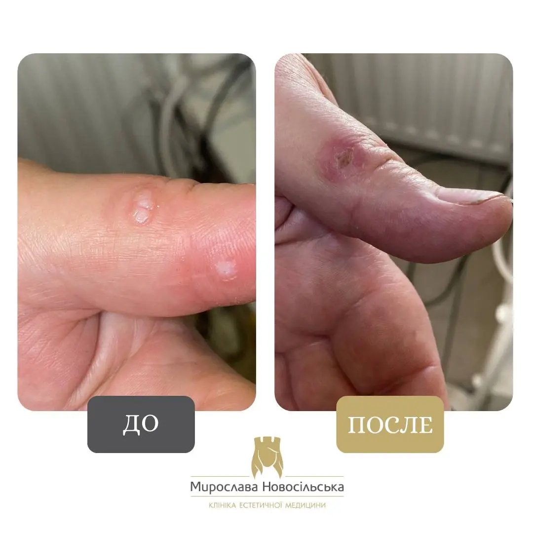 Замораживание бородавок, фото 12