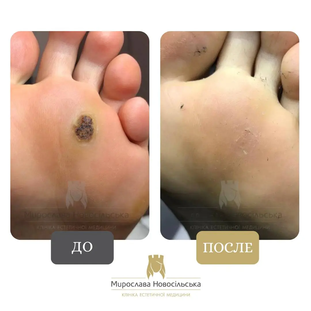 Замораживание бородавок, фото 4