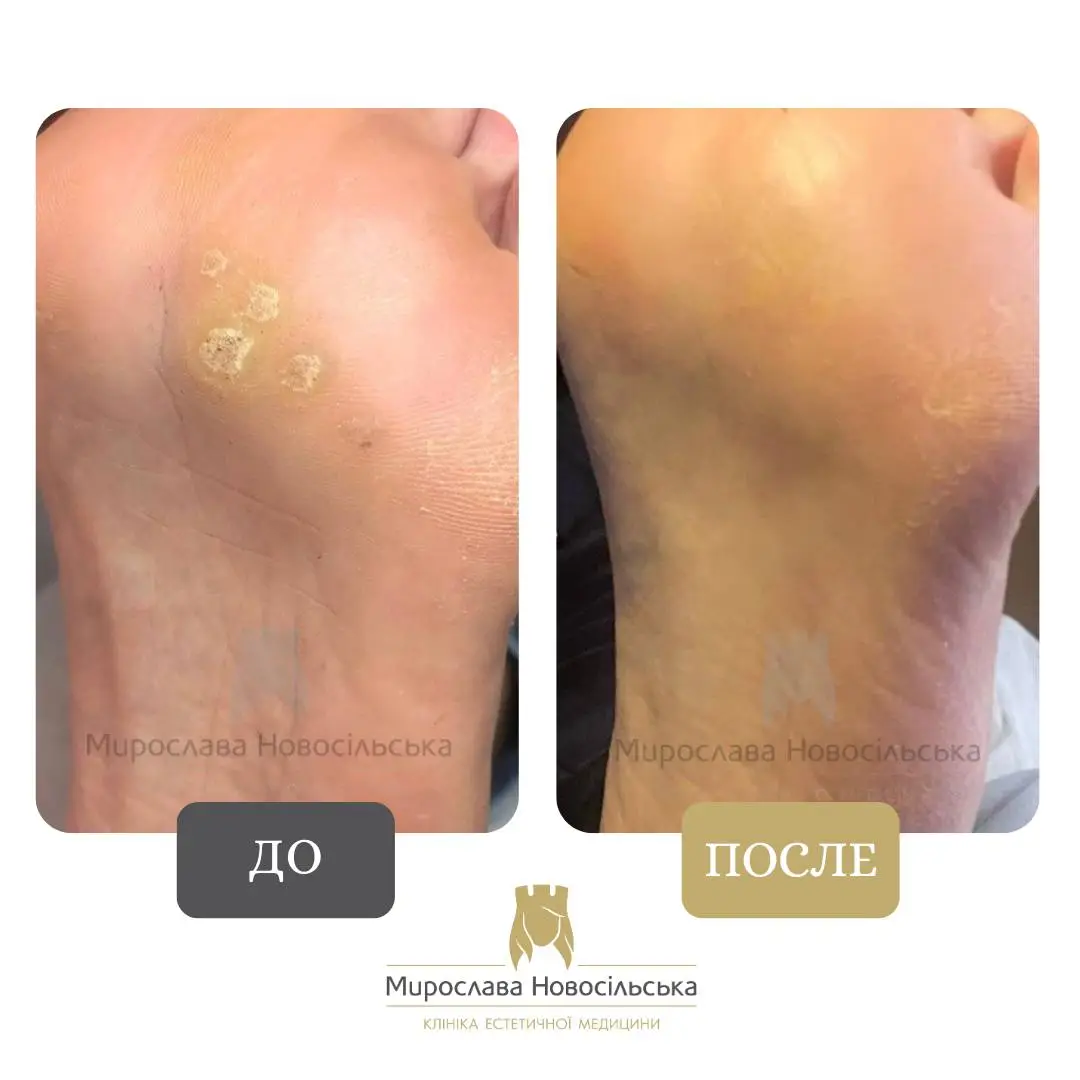 Замораживание бородавок, фото 5