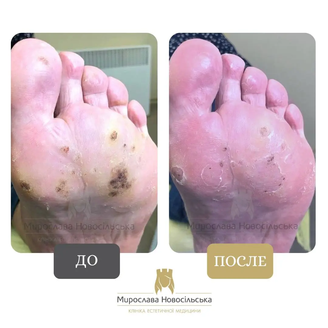 Замораживание бородавок, фото 6