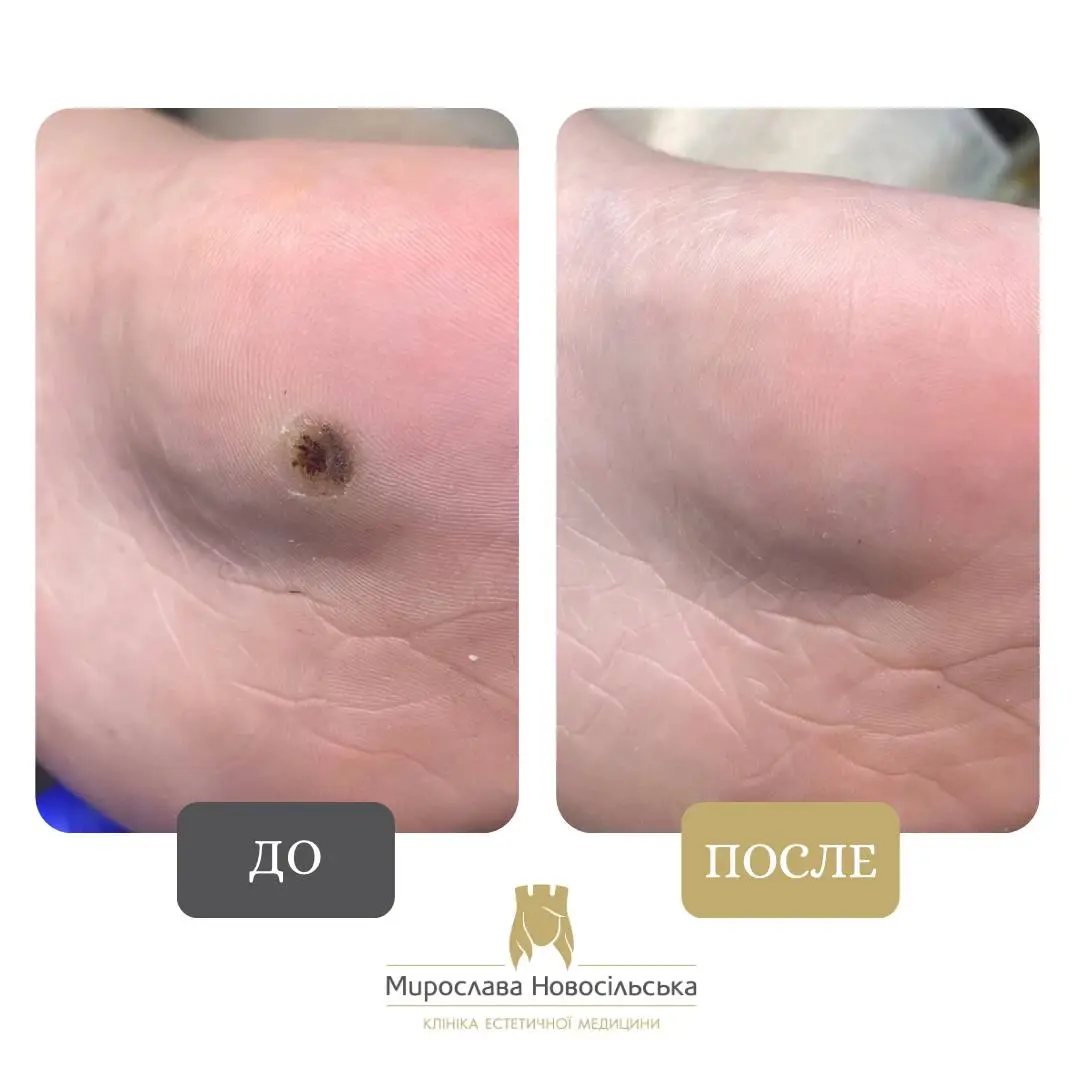 Замораживание бородавок, фото 15