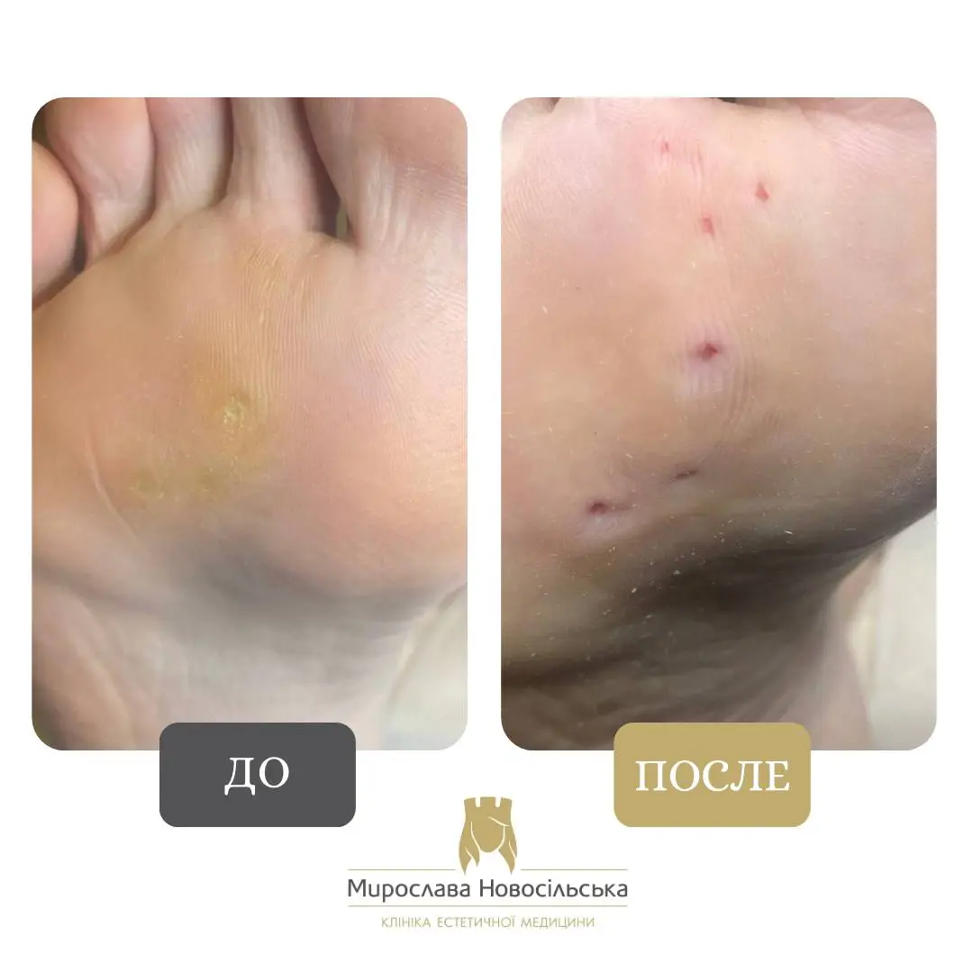 Замораживание бородавок, фото 7