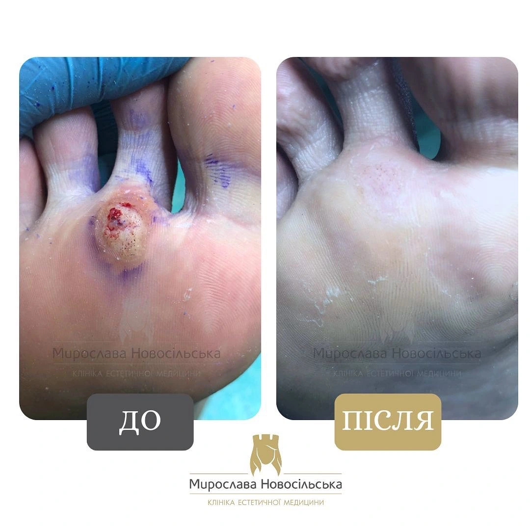 Заморожування бородавок, фото 3