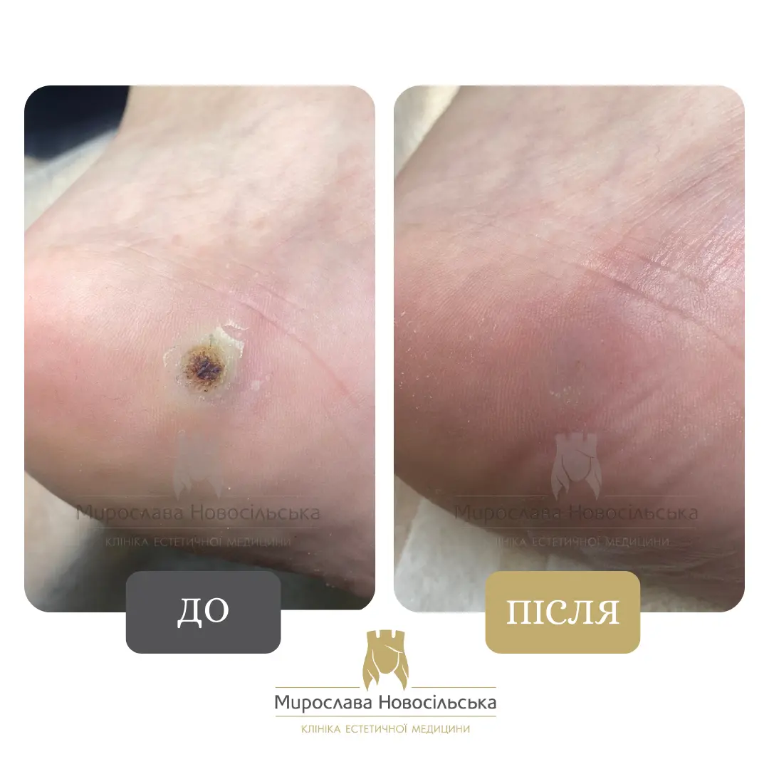 Заморожування бородавок, фото 13