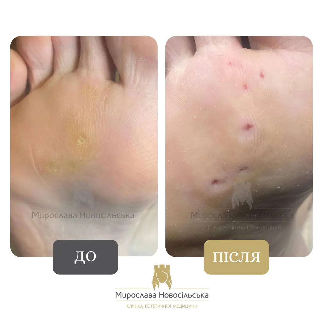 Заморожування бородавок, фото 7