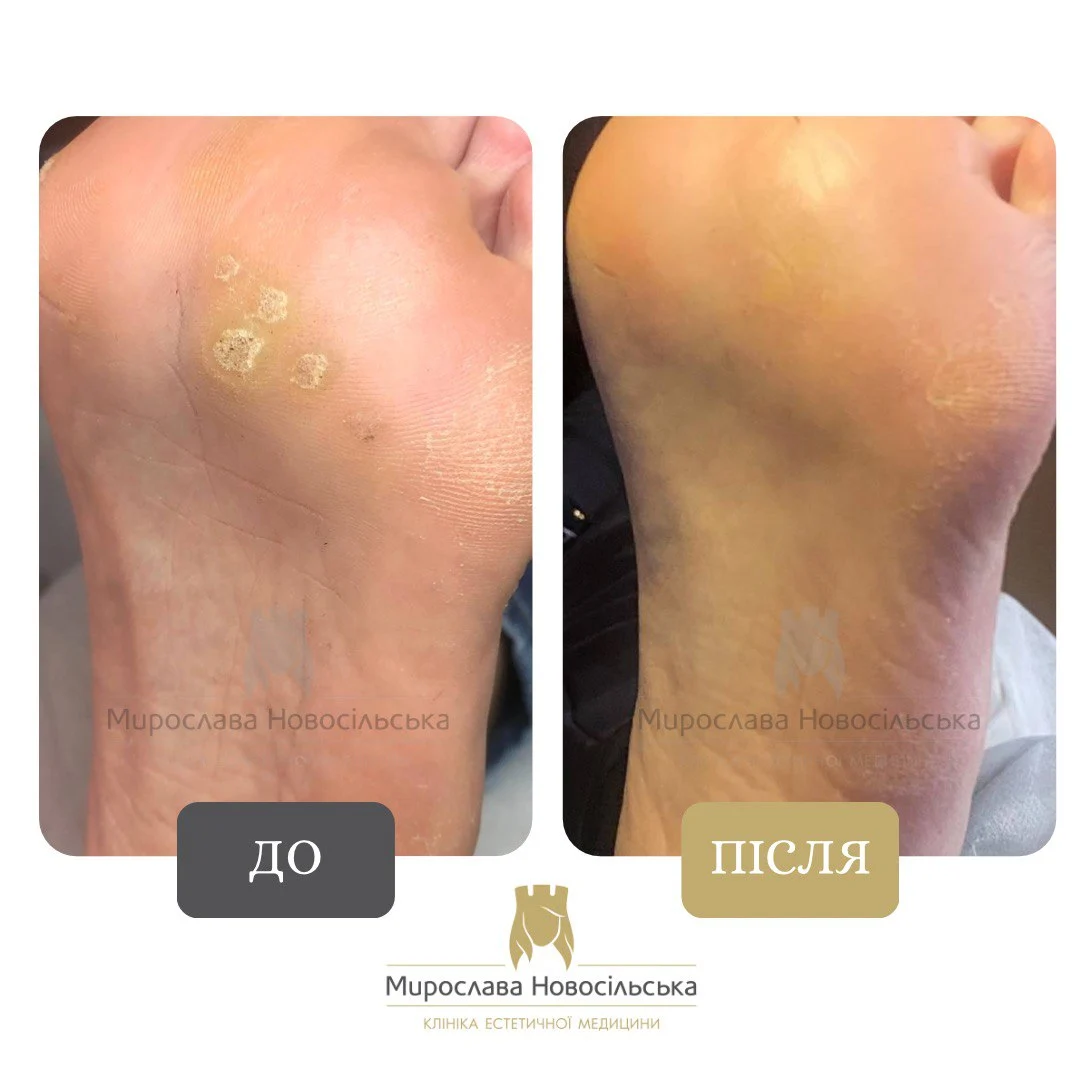 Заморожування бородавок, фото 5