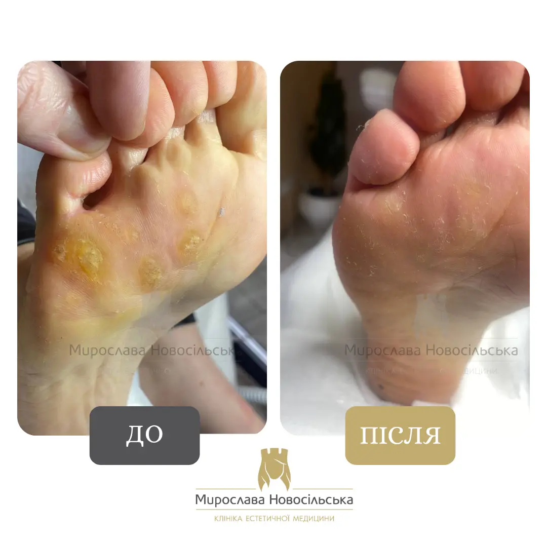 Заморожування бородавок, фото 2