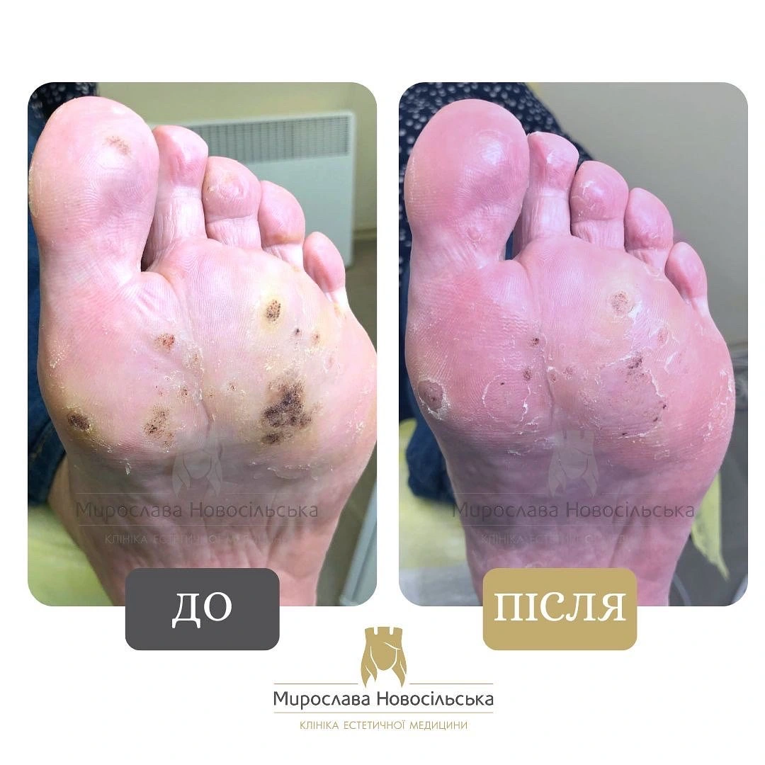 Заморожування бородавок, фото 6