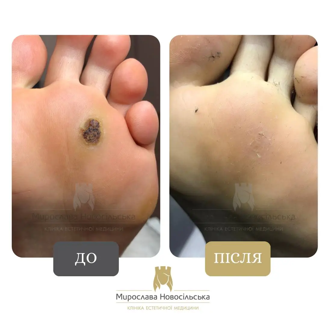 Заморожування бородавок, фото 4