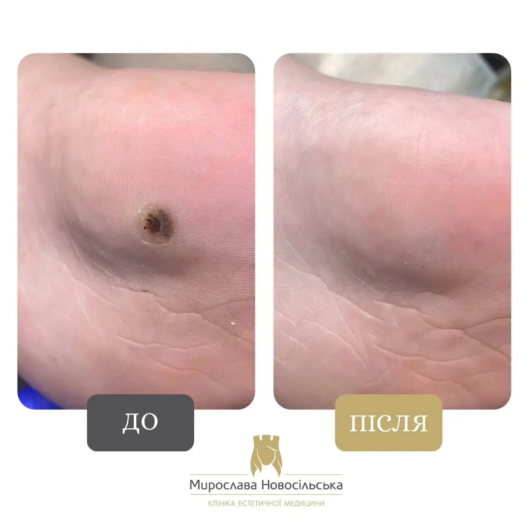 Заморожування бородавок, фото 15