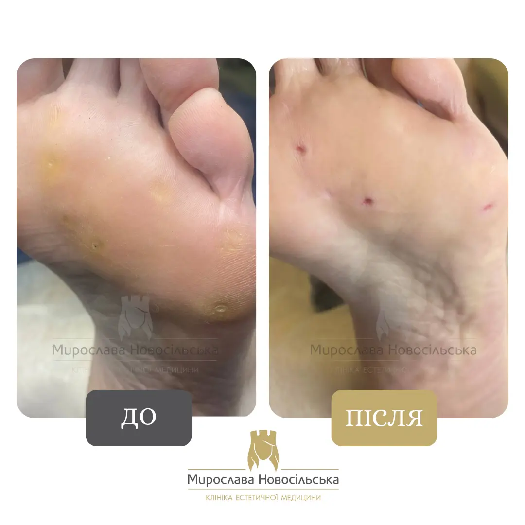 Заморожування бородавок, фото 8