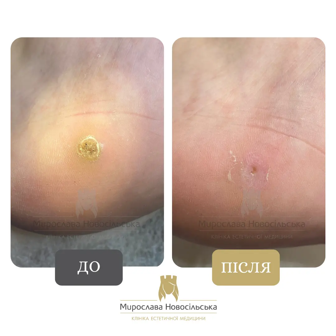 Заморожування бородавок, фото 9