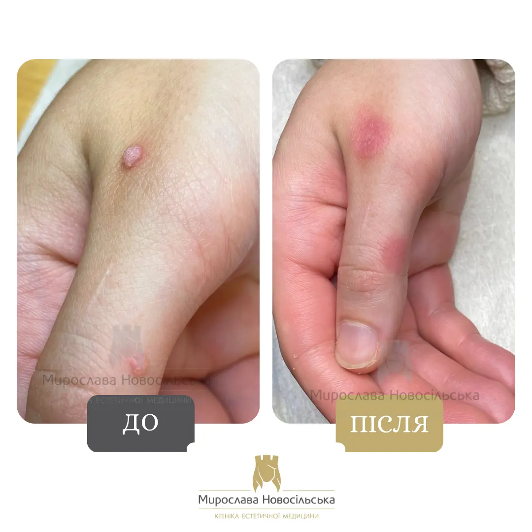 Заморожування бородавок, фото 10