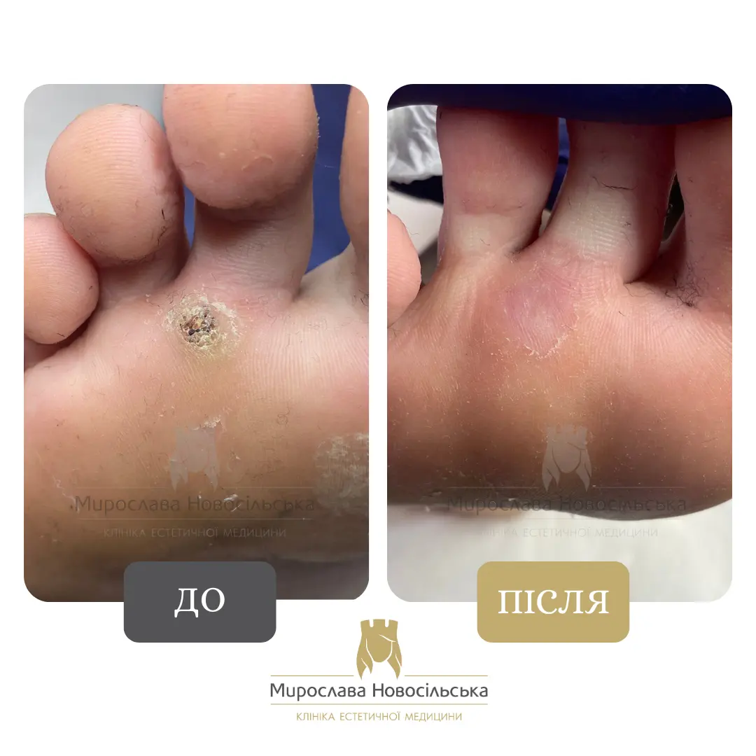 Заморожування бородавок, фото 11