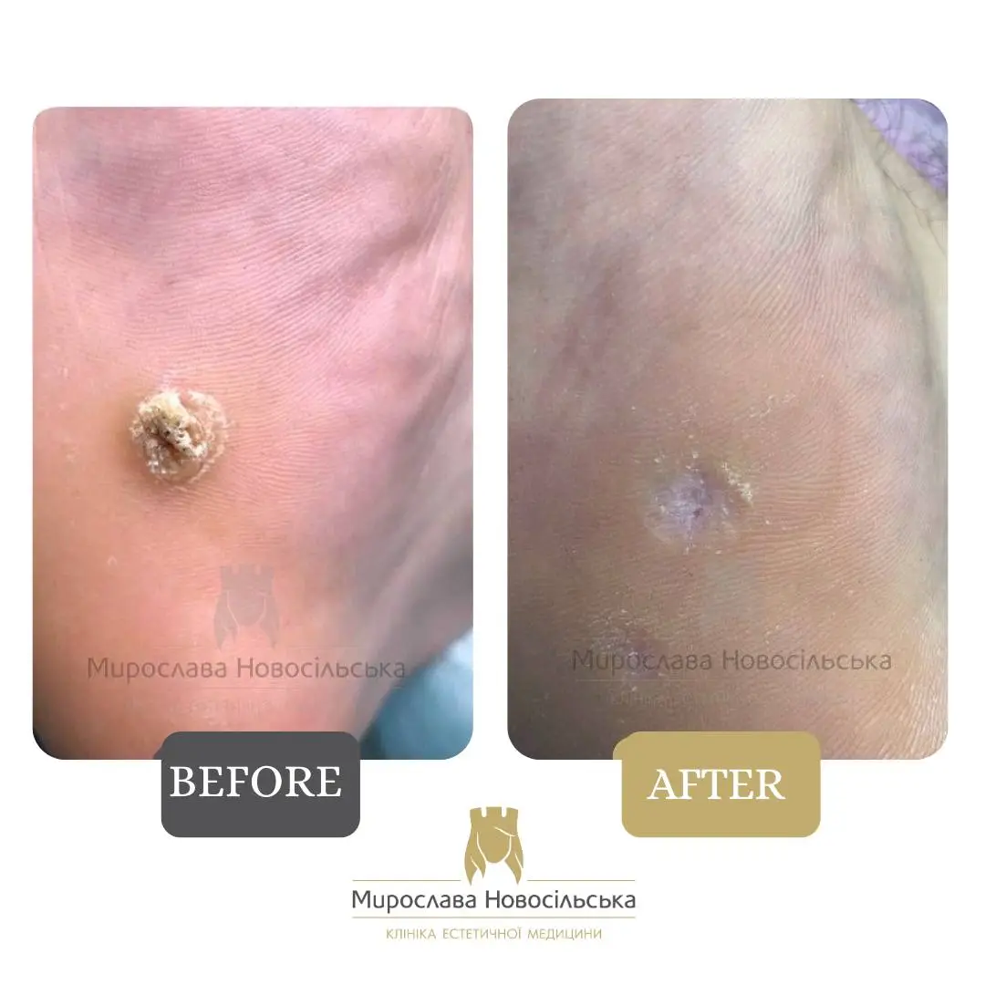 Removal of calluses, photo 4