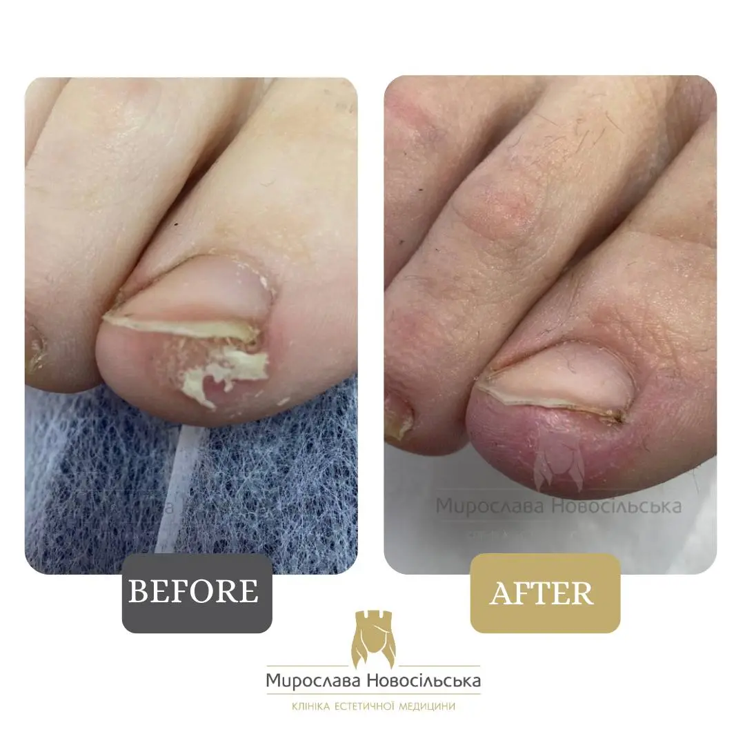 Removal of calluses