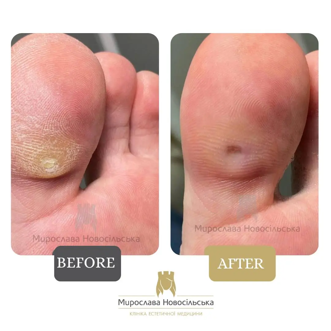 Callus removal with liquid nitrogen