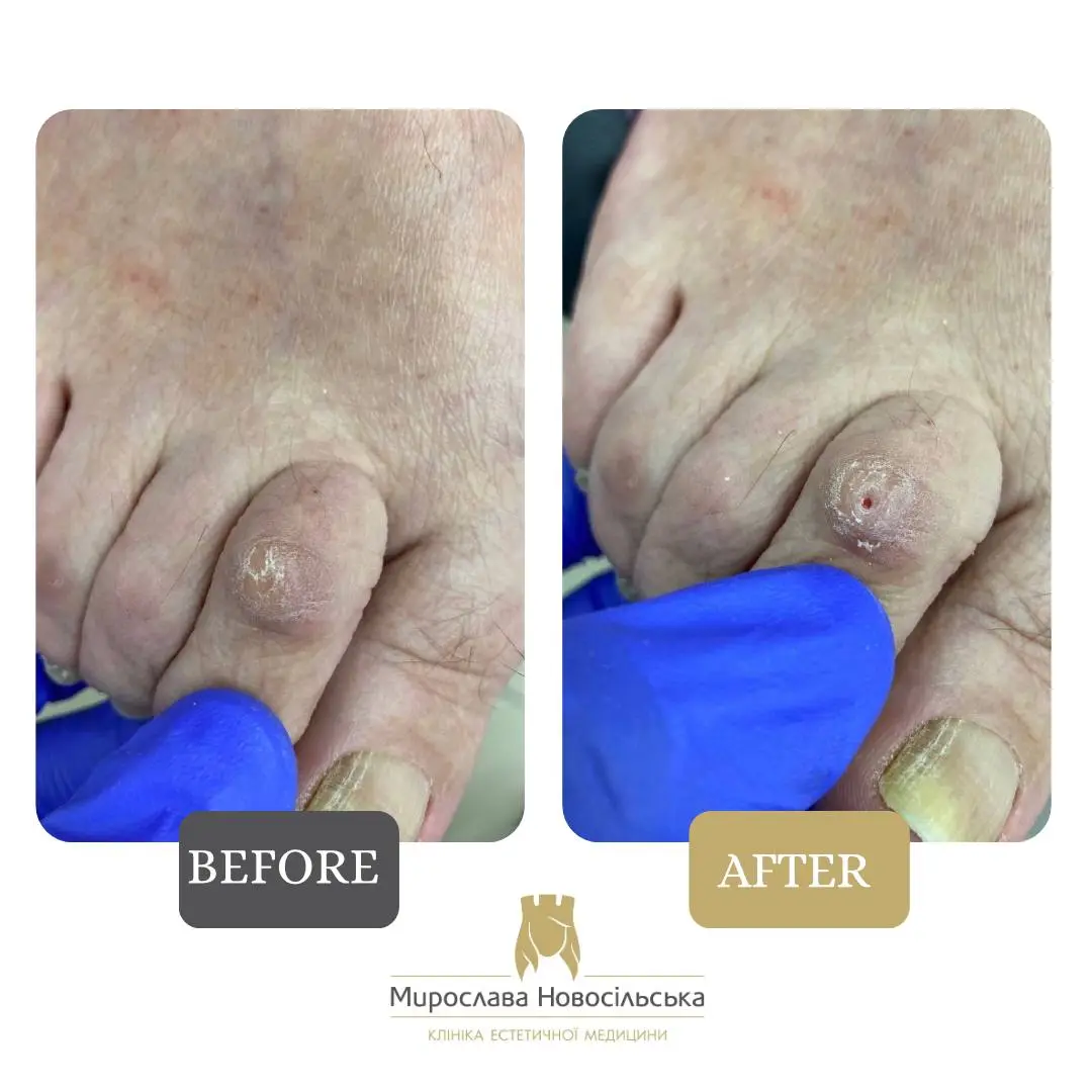 Removal of stem callus