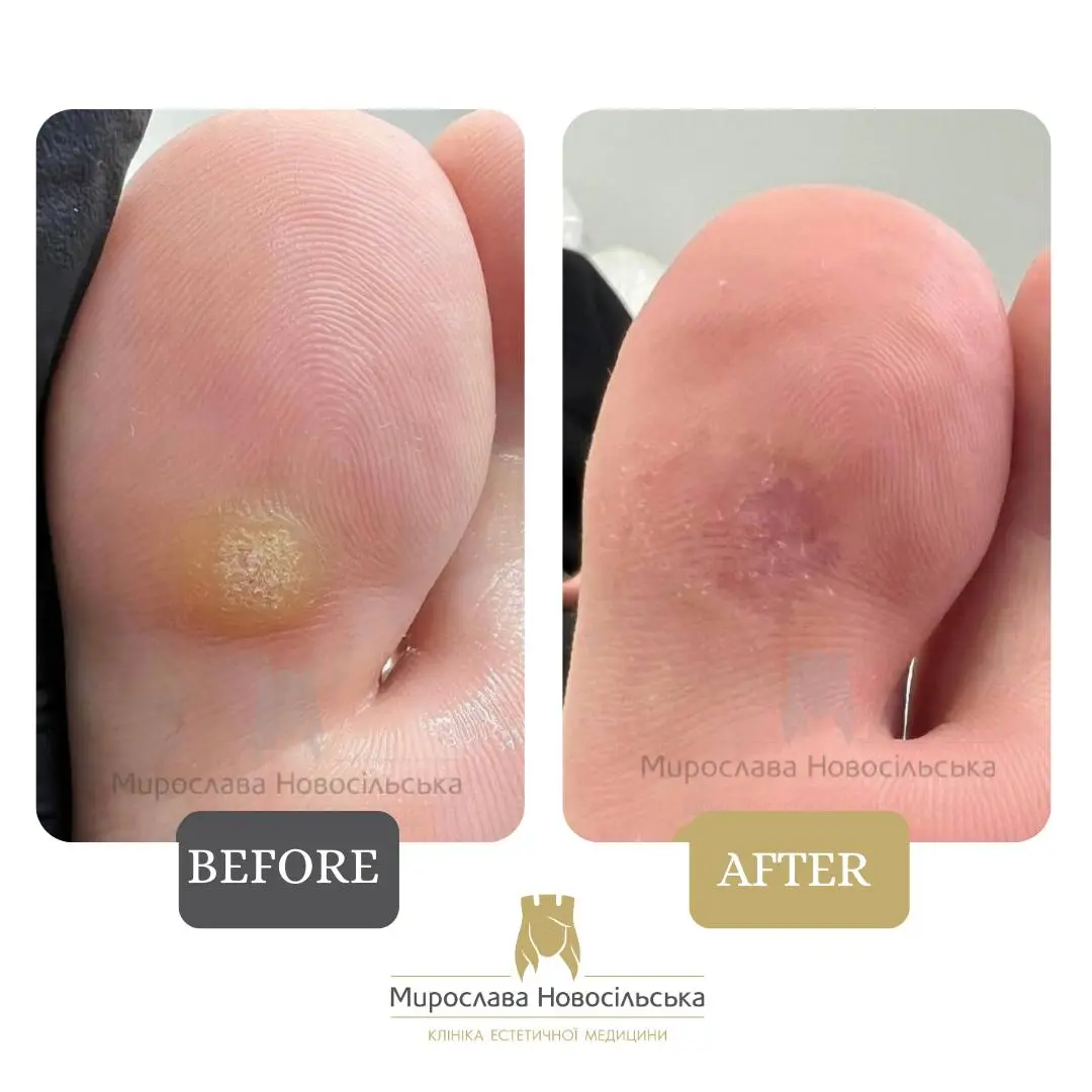 Removal of calluses, photo 2