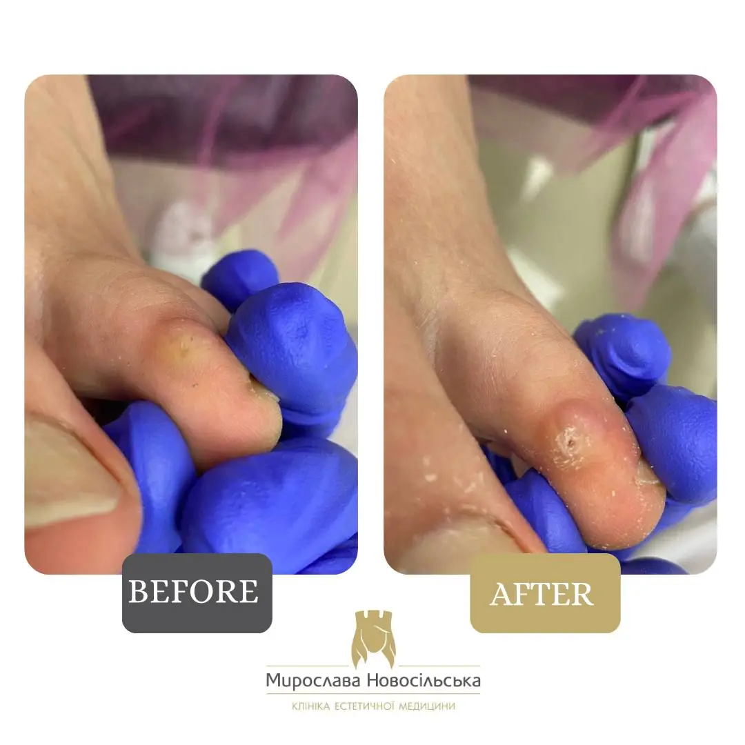 Removal of calluses, photo 6