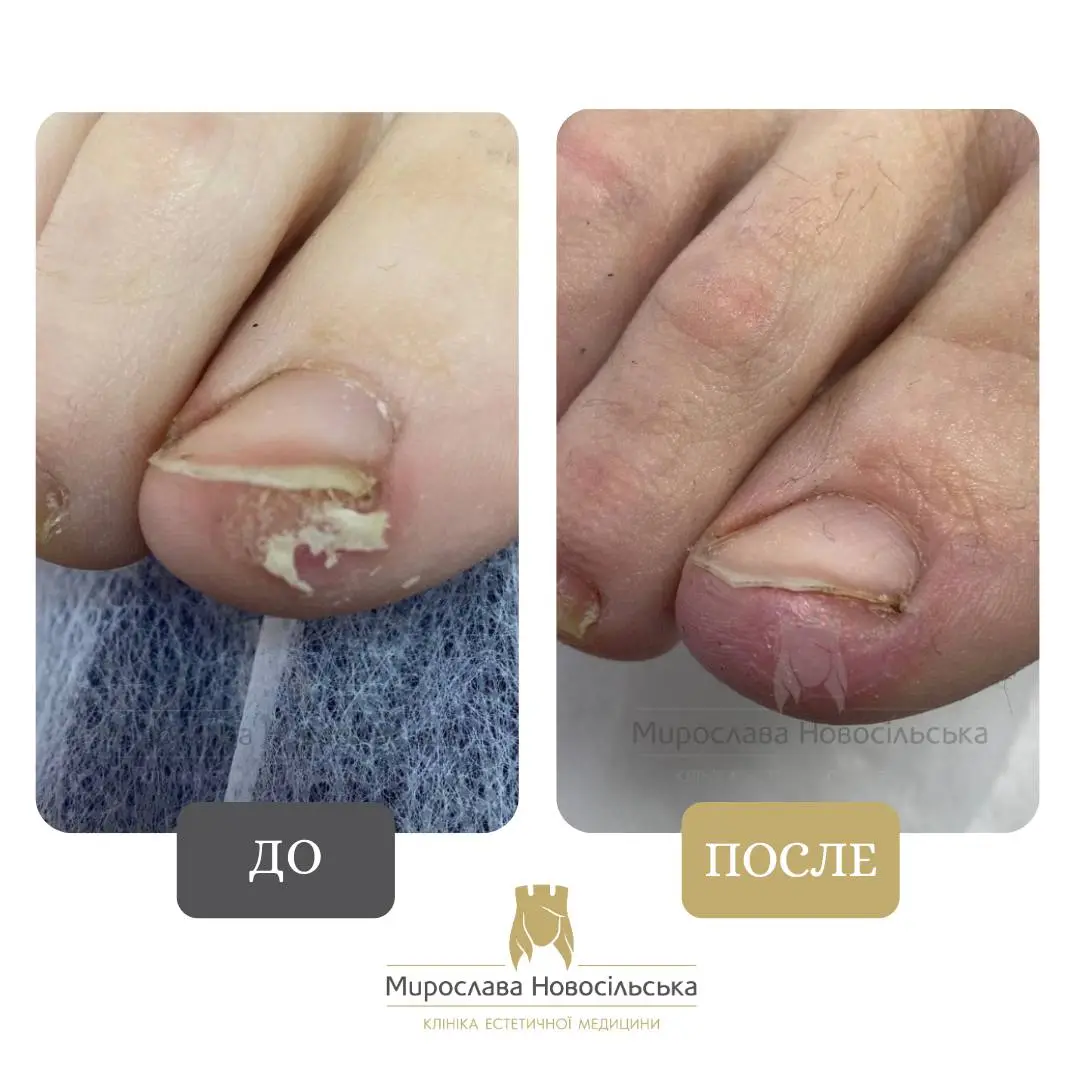 Удаление стержневого мозоля, фото 2