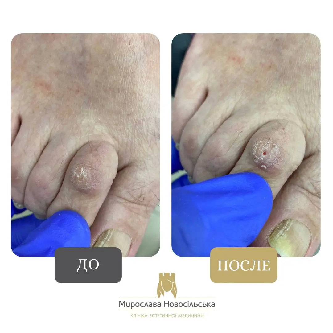 Удаление стержневого мозоля, фото 4