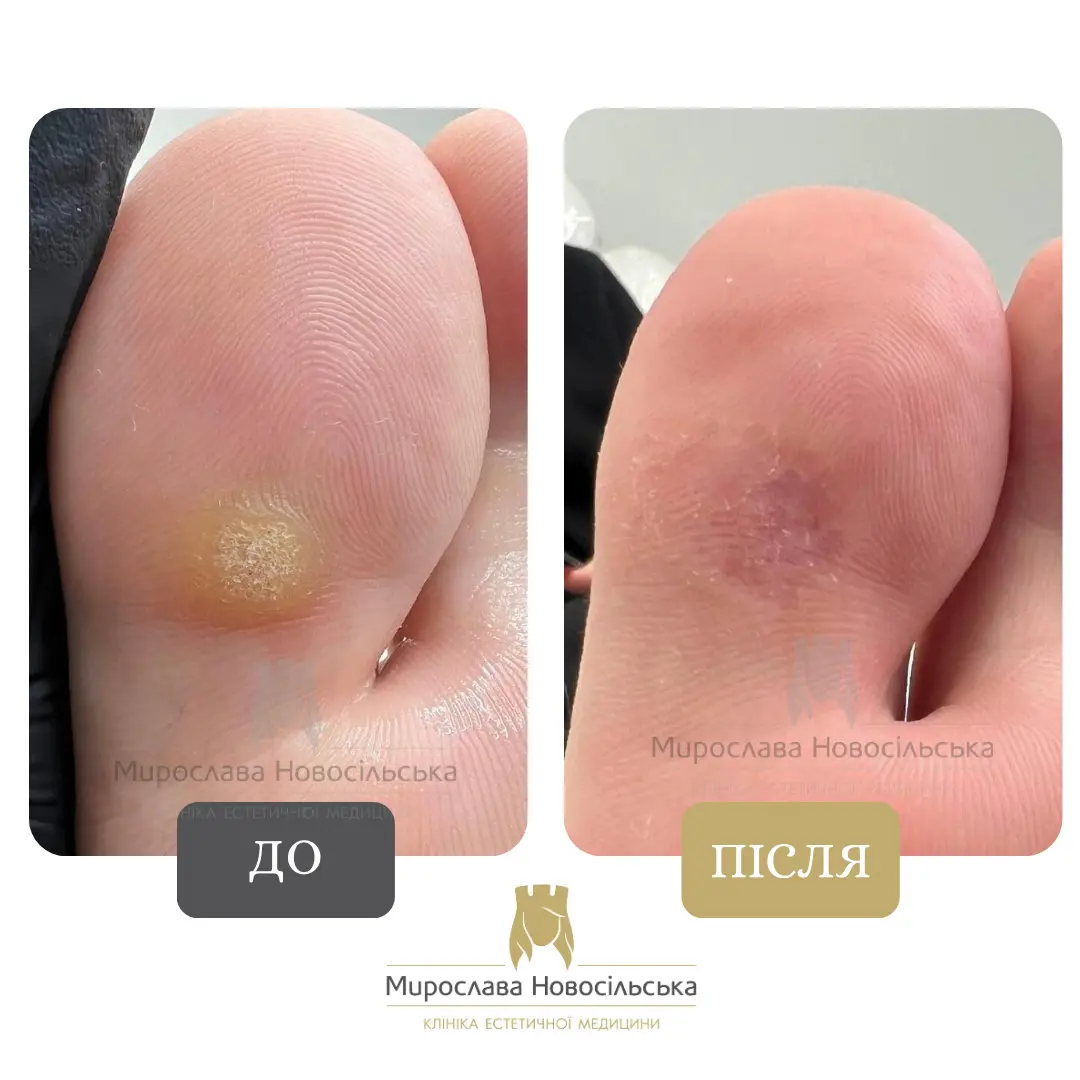 Видалення мозоля рідким азотом, фото 2