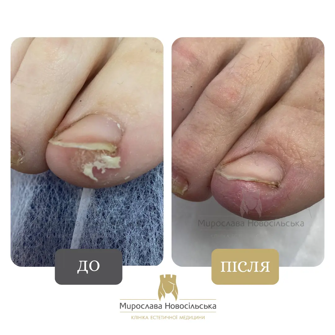 Видалення стрижневого мозоля, фото 2