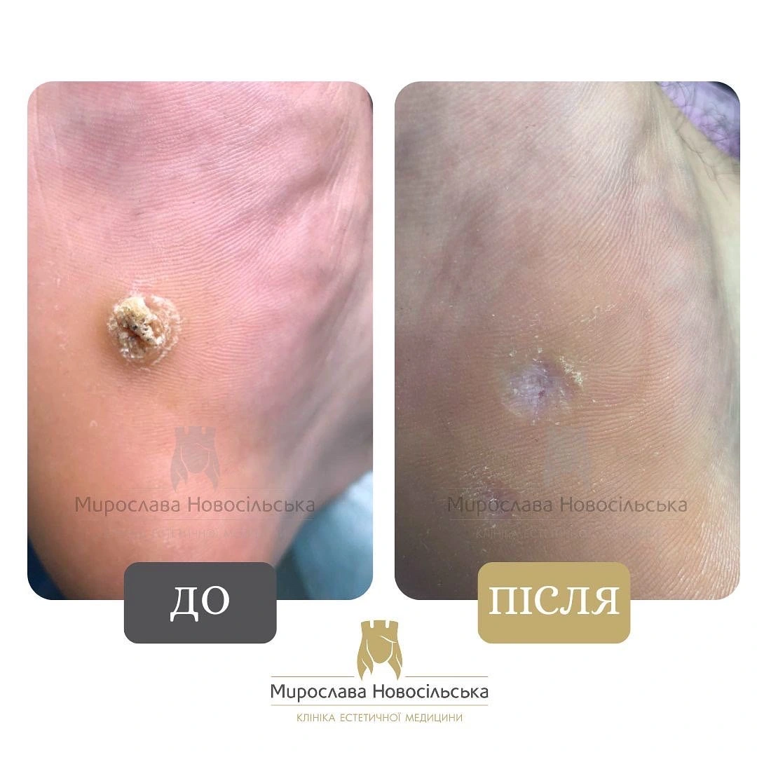 Видалення мозоля рідким азотом, фото 4