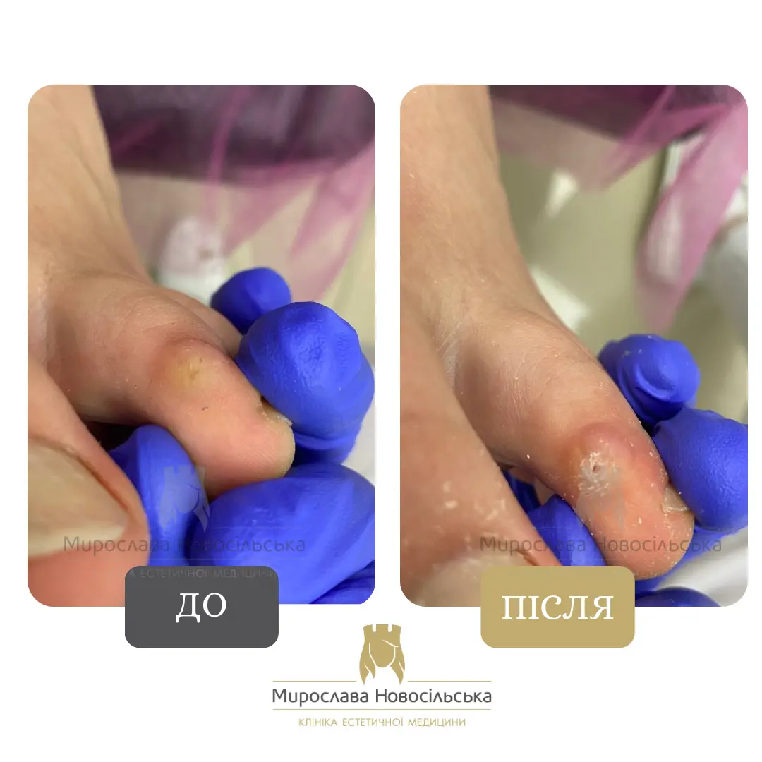 Видалення стрижневого мозоля, фото 3