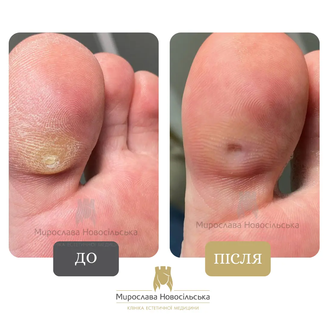 Видалення мозоля рідким азотом, фото 3