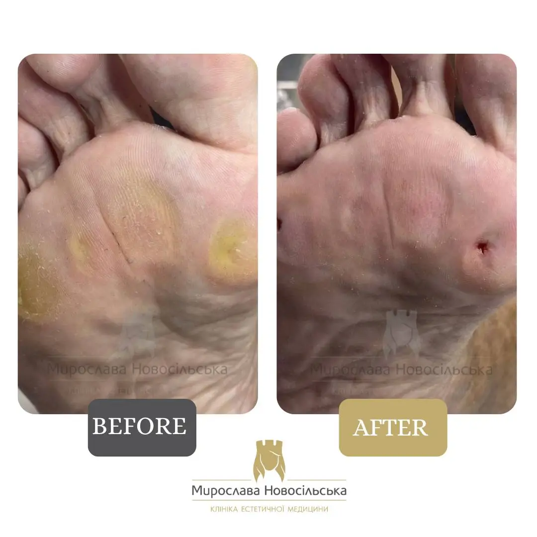 Removal of corns, photo 4