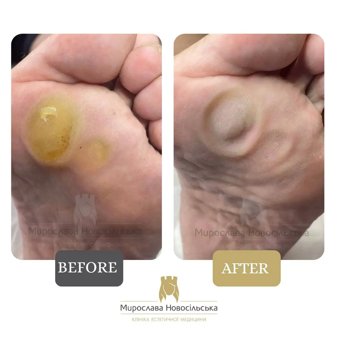 Removal of corns, photo 3