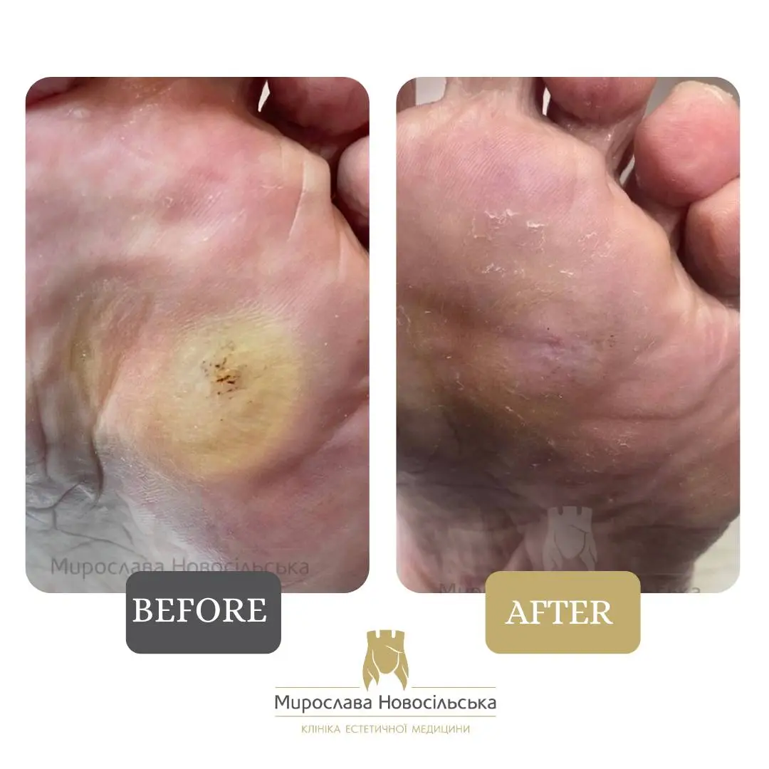 Removal of corns, photo 2