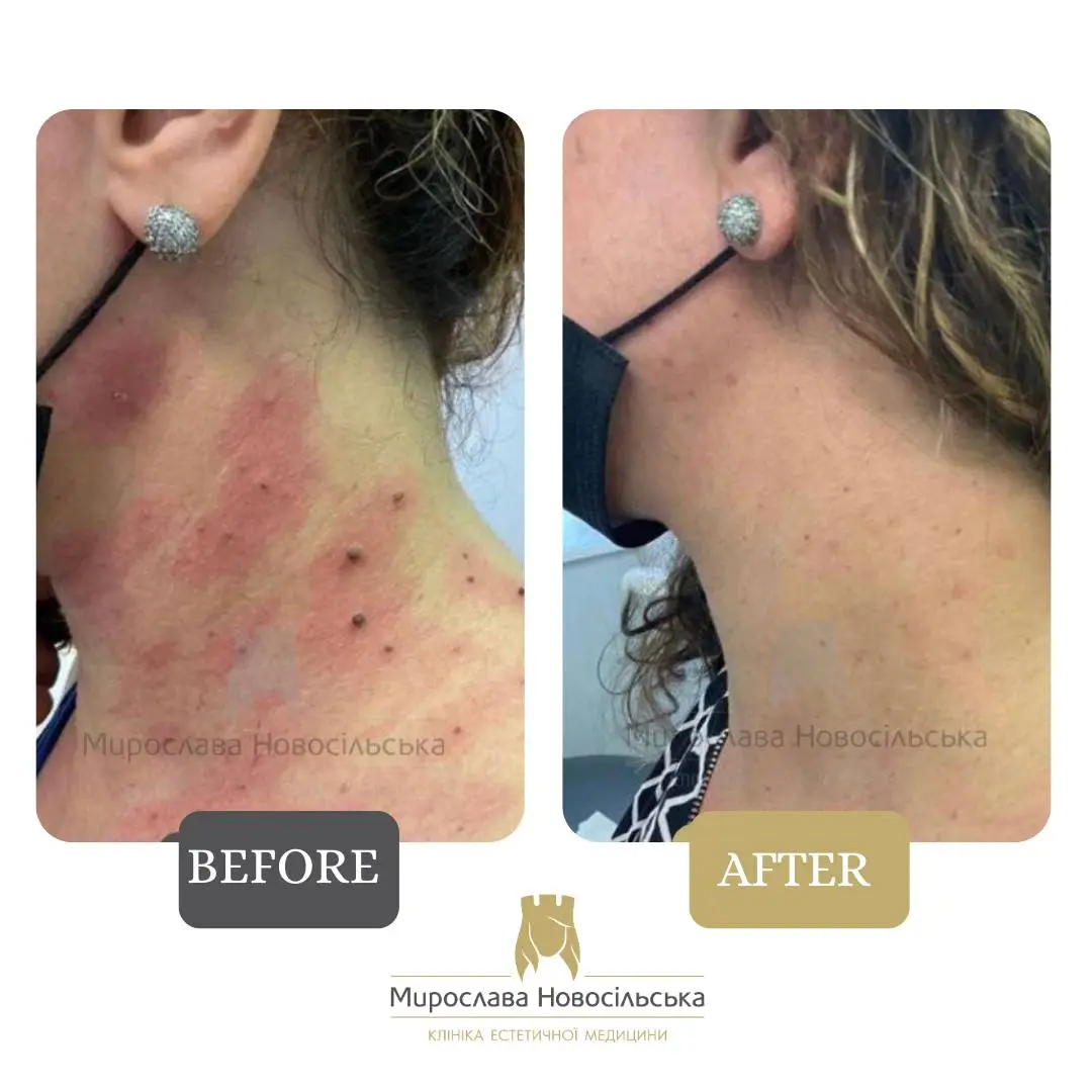 Removal of papilloma, photo 2