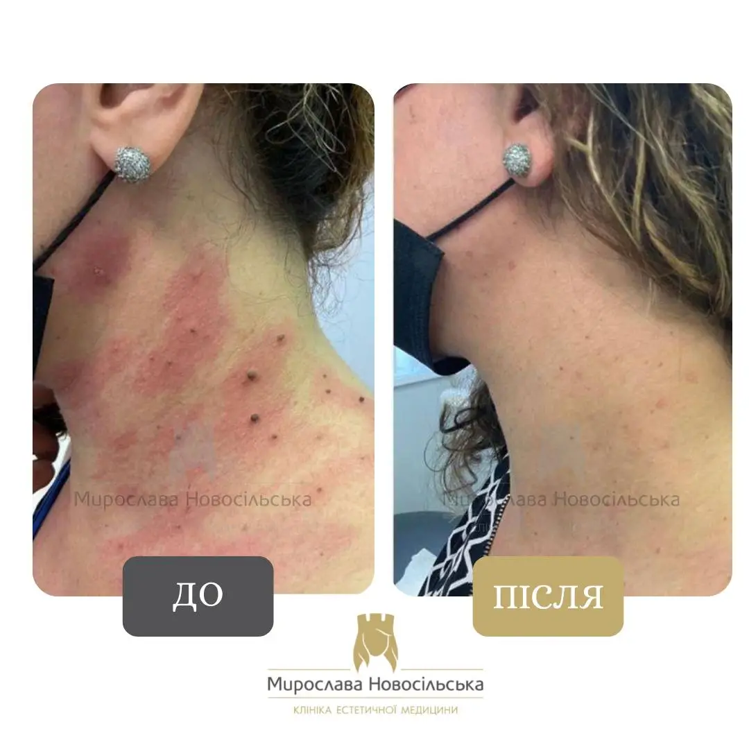 Видалення папіломи лазером, фото 2