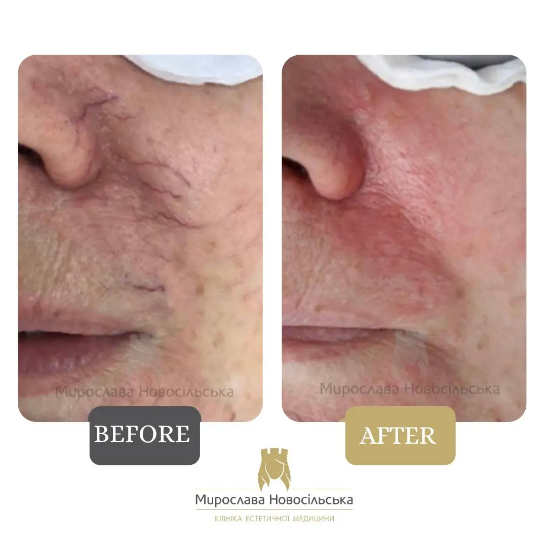 Laser removal of blood vessels, photo 3