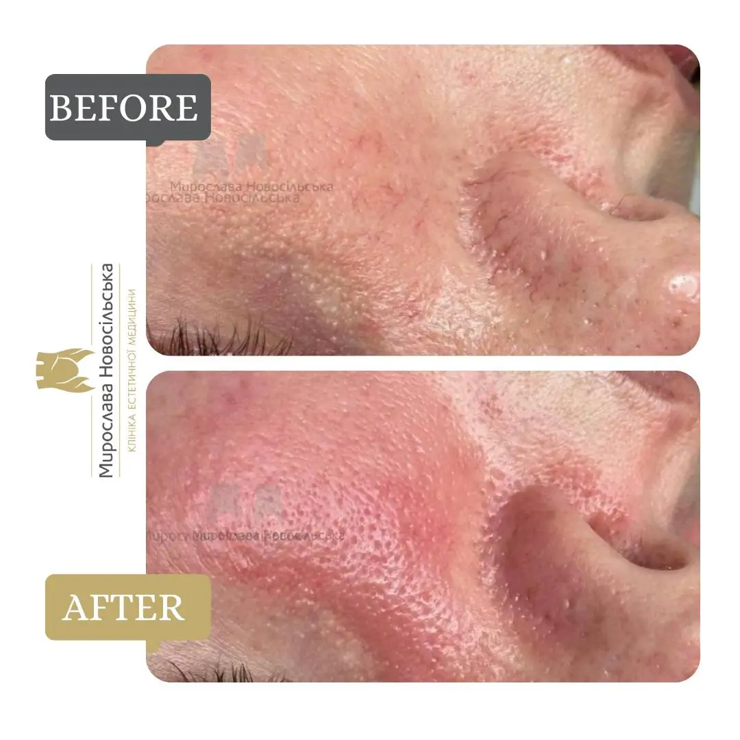 Laser removal of blood vessels, photo 8