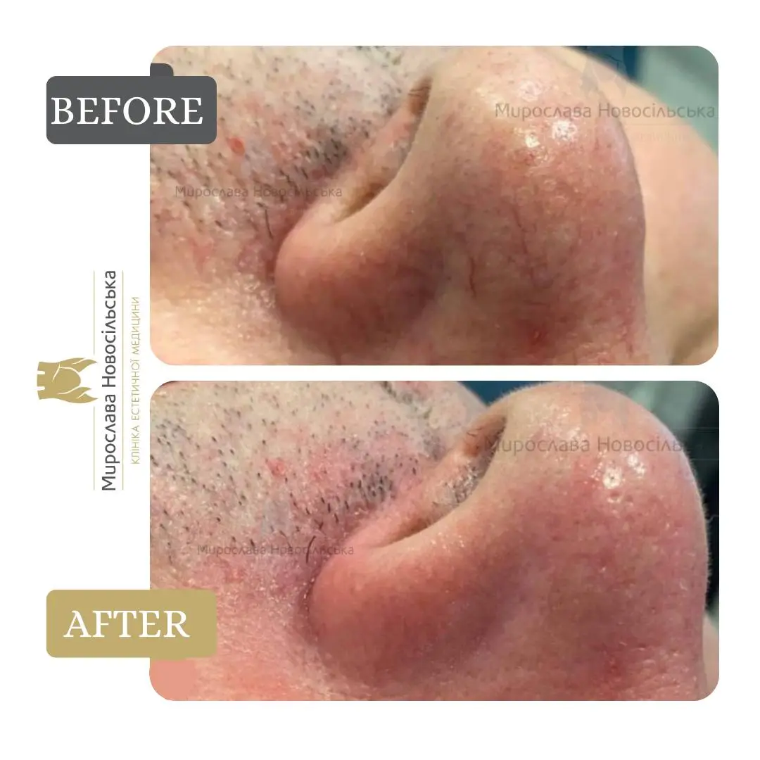 Laser removal of blood vessels, photo 5