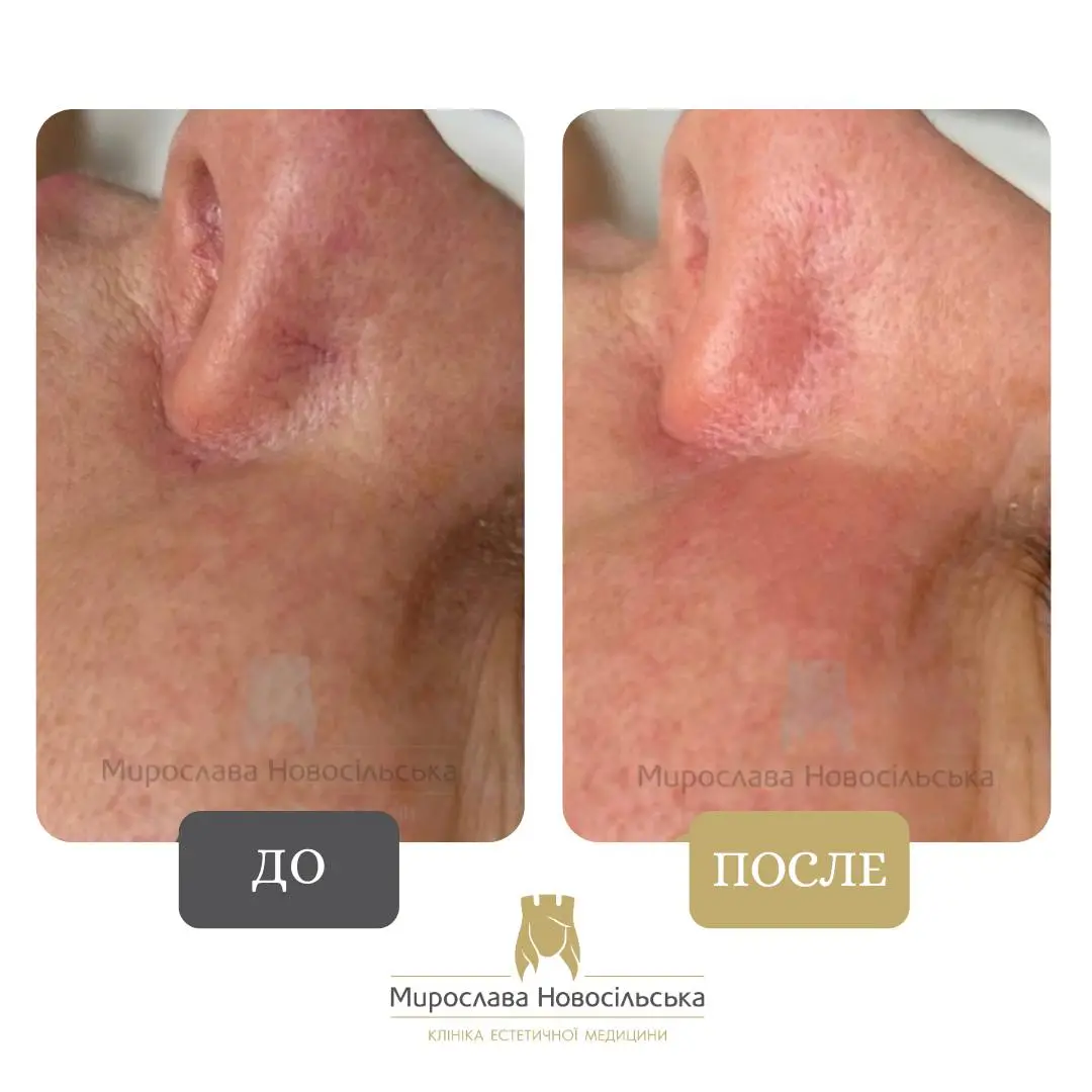 Лазерное удаление сосудов, фото 6