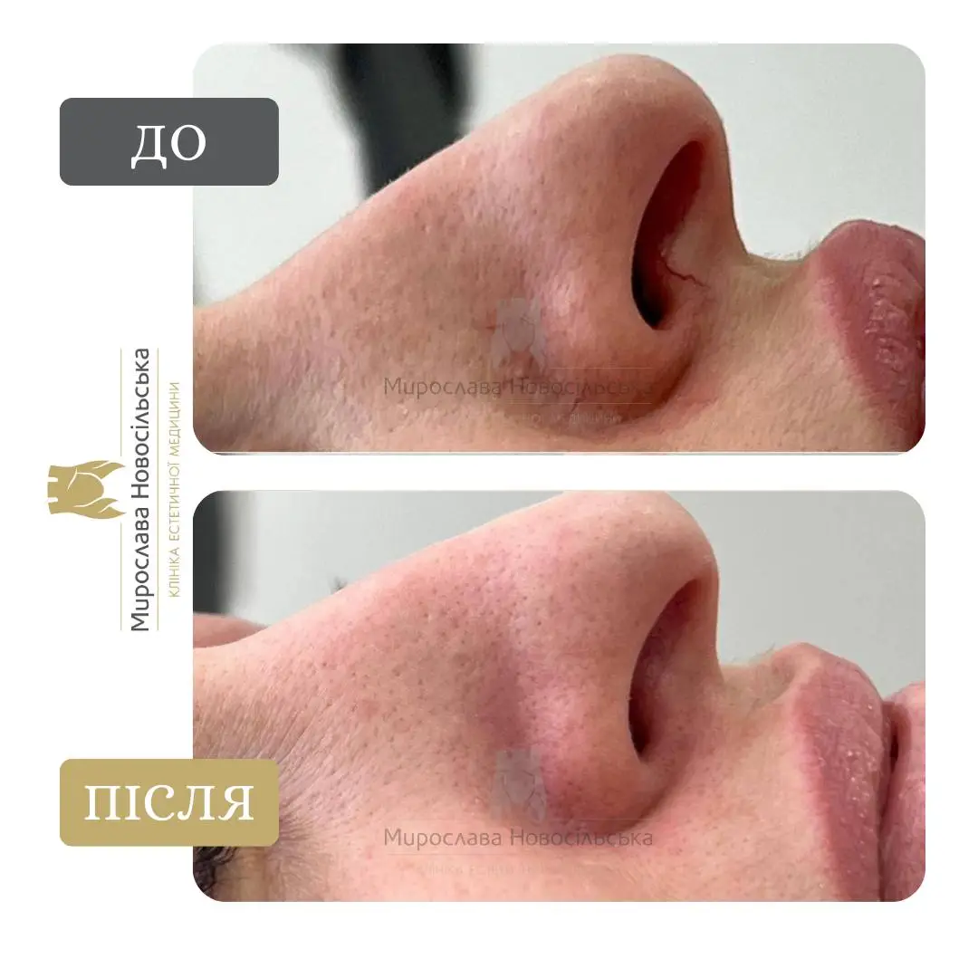 Лазерне видалення судин, фото 2