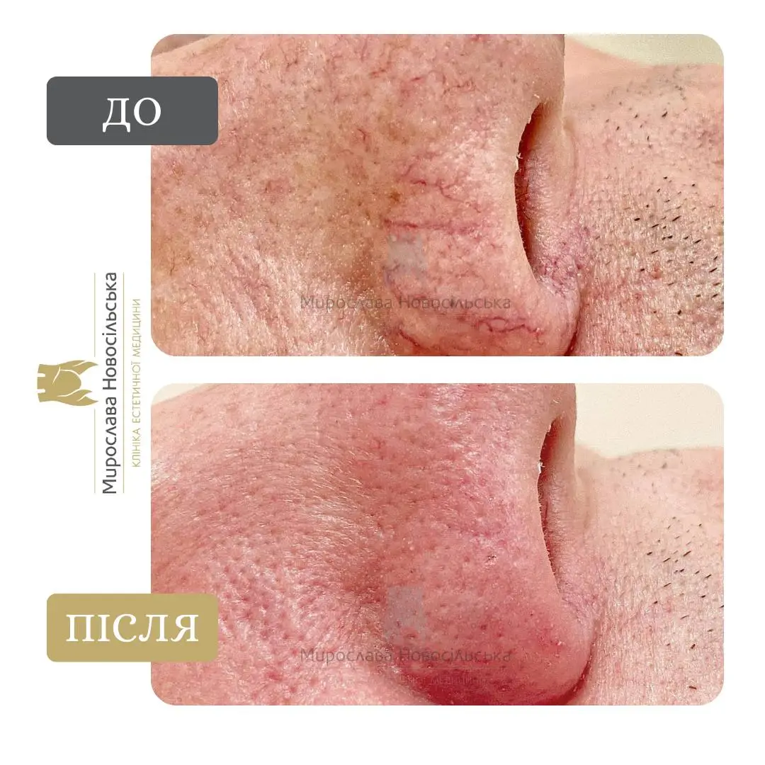 Лазерне видалення судин, фото 4