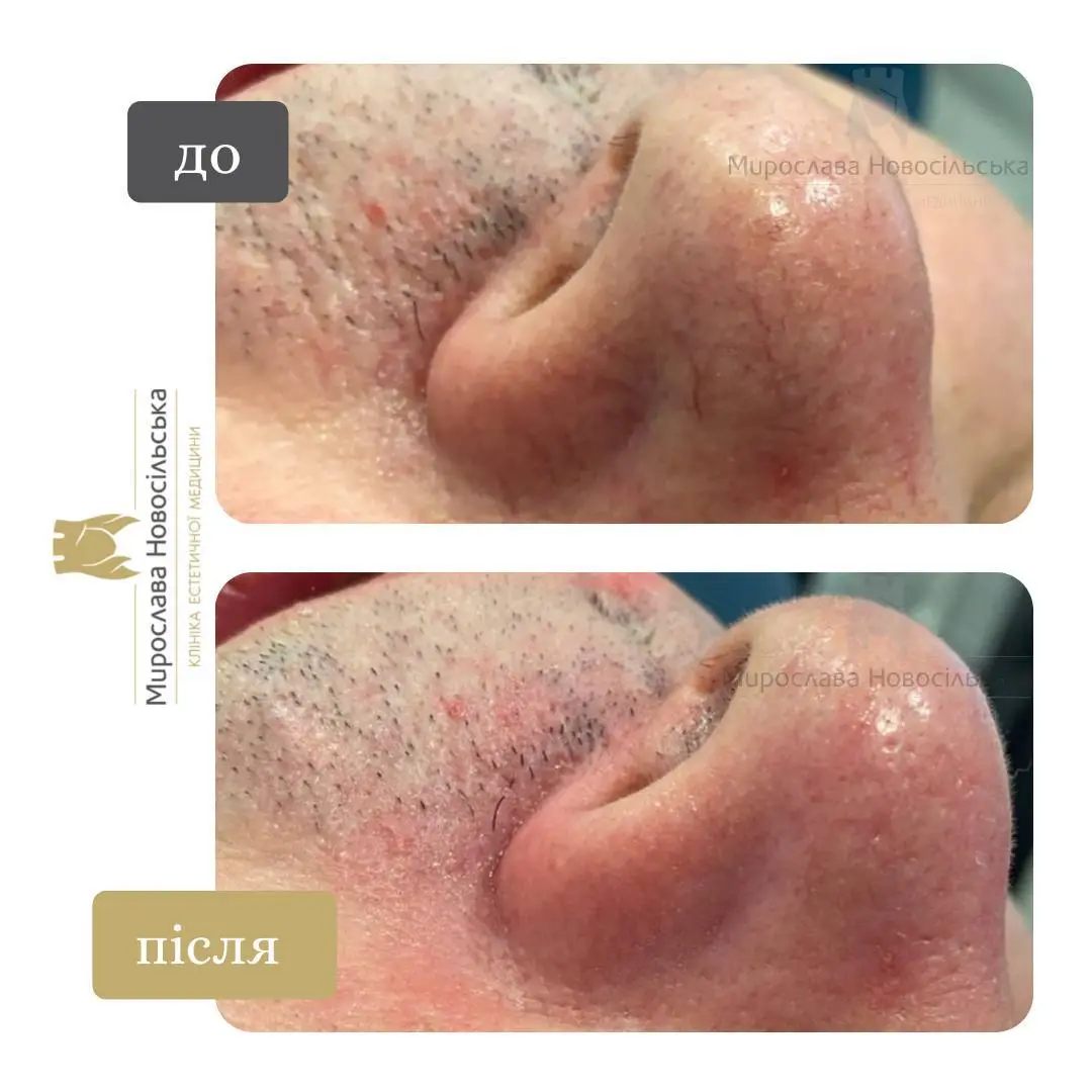 Лазерне видалення судин, фото 5