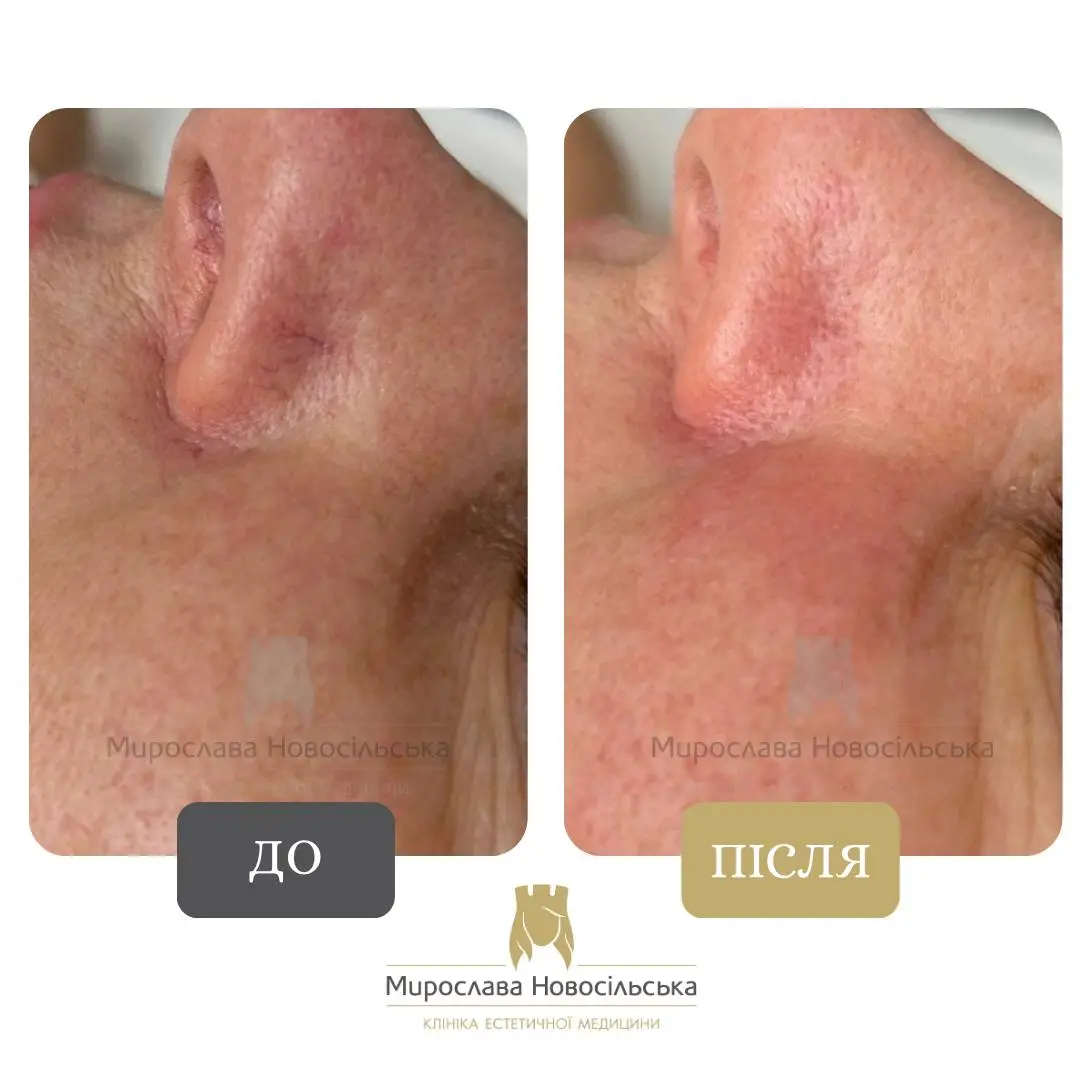 Лазерне видалення судин, фото 6